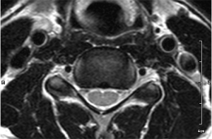頸椎MRI水平断
