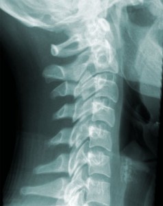頸椎X線画像