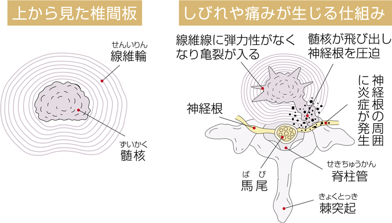 椎間板の構造